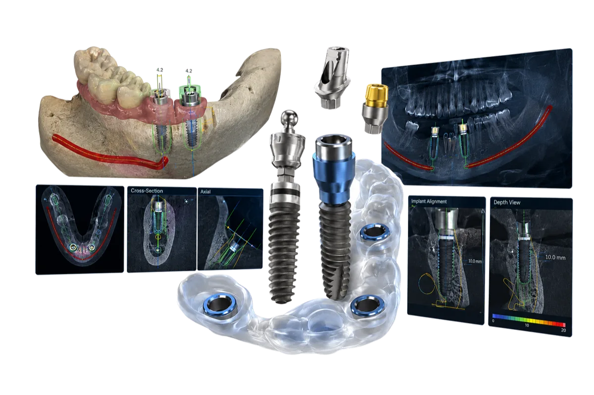 3D 네비게이션 임플란트
